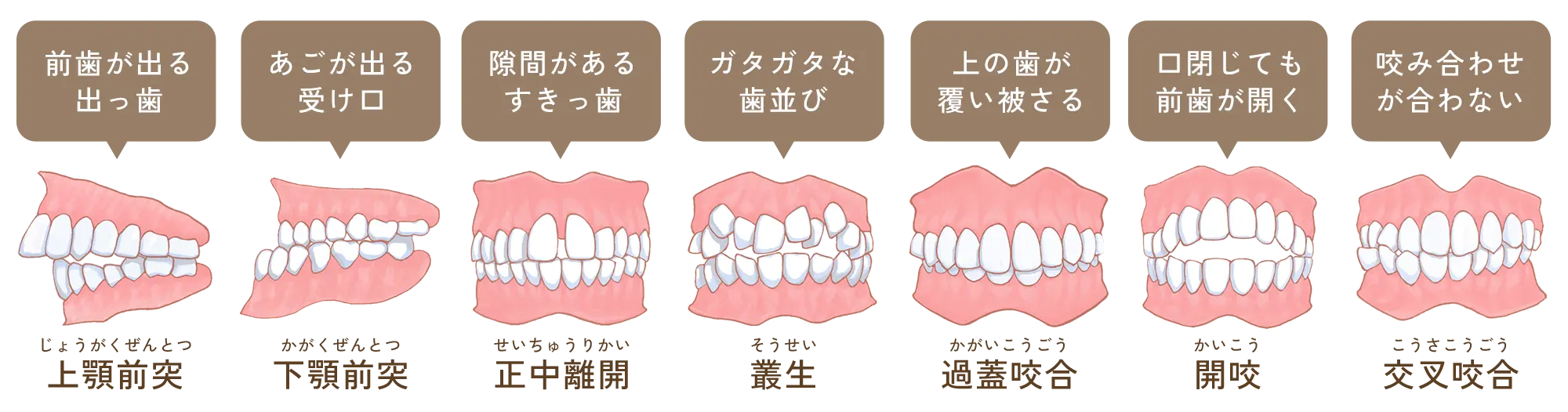 悪い歯並び