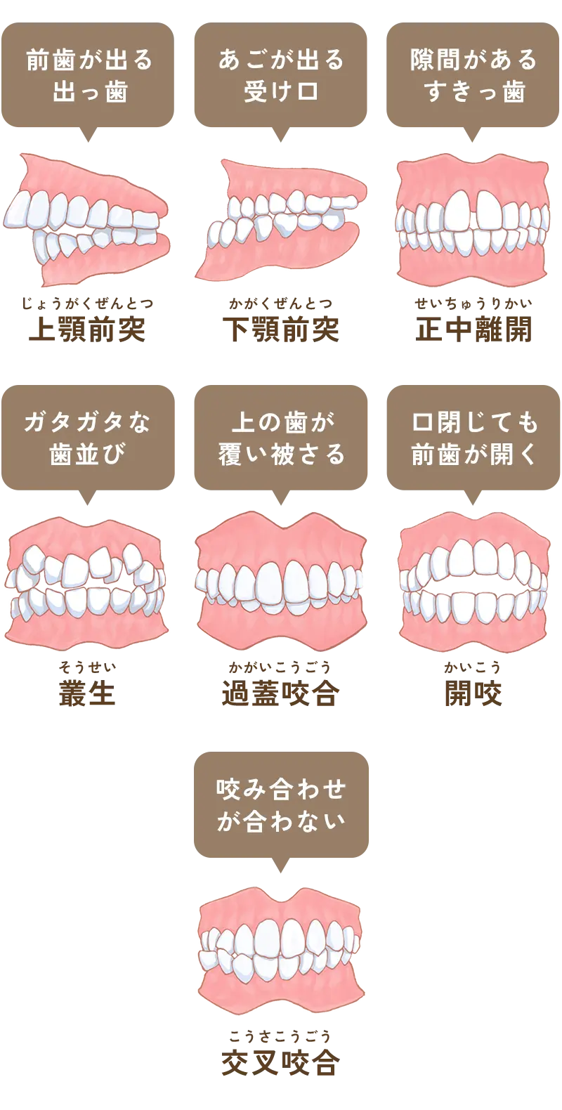 悪い歯並び
